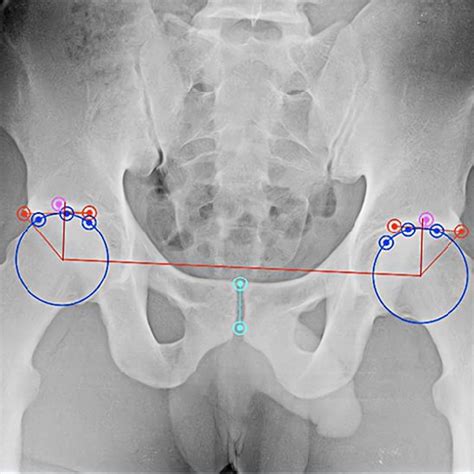 Ap Pelvis Radiograph With Osirix Measurements For Lateral Center Edge