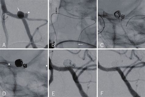 Ntraoperative Postoperative Images Working Angle A Kissing