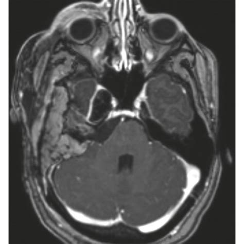 Imaging Of Patient 1 A Preoperative Contrast Enhanced Axial T1 Mri