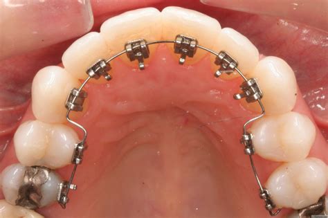 Fixed Orthodontic Appliances Pptx Drhakam Muhadharaty