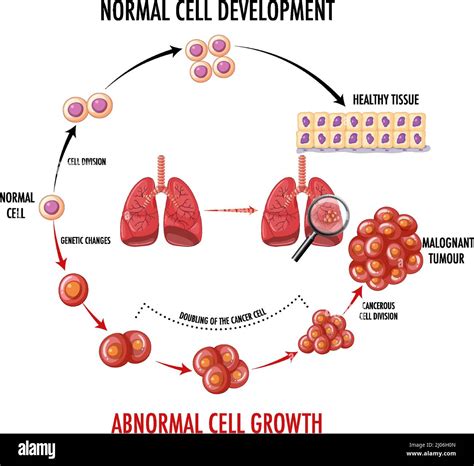 Diagram Showing Cancer Development Process Illustration Stock Vector Image And Art Alamy