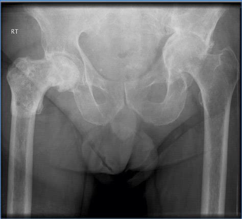 AP Pelvis On Admission Demonstrating A Pathological Subtrochanteric