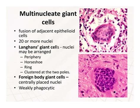Granuloma Inflammation Powerpoint Presentation Ppt