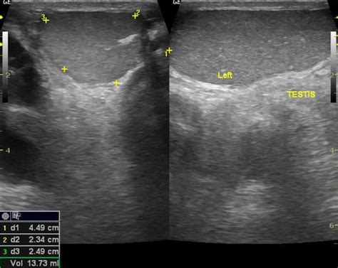 Hematocele Ultrasound