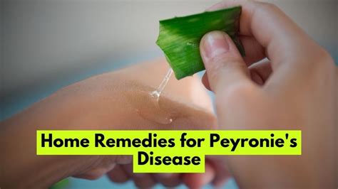 Home Remedies For Peyronie S Disease Comprehensive Guide