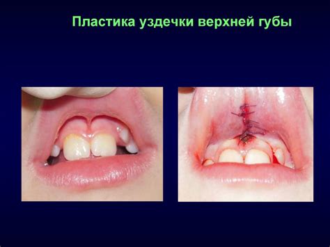 Аномалии развития слизистой оболочки полости рта - презентация онлайн