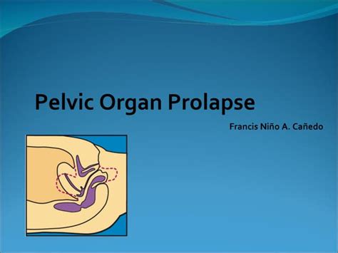 Pelvic Organ Prolapse Fnac Ppt