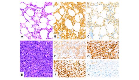 Bone Marrow Trephine Biopsy Showing Extensive Marrow Engagement By