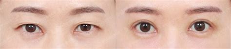 Double Eyelid Surgery In Korea Best Clinics Costs Procedure Details And More