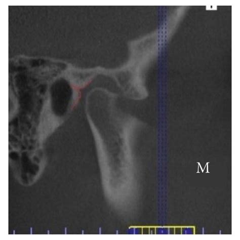 Example of three types of petrotympanic fissure positioning: (a) low-L ...