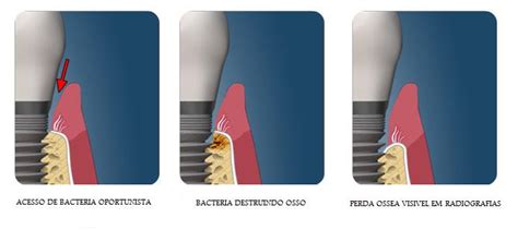 Peri Implantite Saiba O Que E Como Prevenir