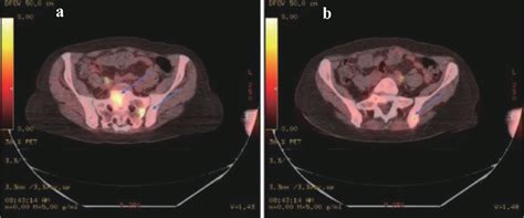 Figure 5 from Extramedullary Myeloid Leukemia in the Setting of a Myeloproliferative Neoplasm ...