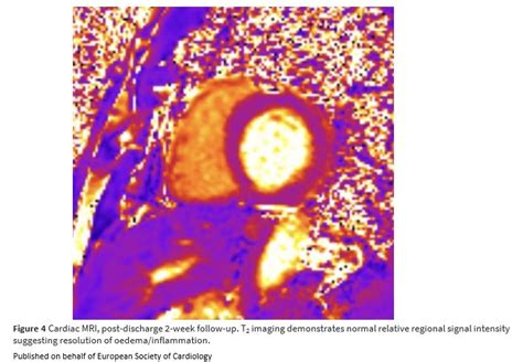 European Society of Cardiology Journals on Twitter: "Human granulocytic anaplasmosis causes ...