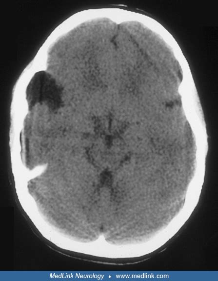 Arachnoid Cyst Medlink Neurology