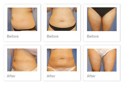 Liposuction Before And After Tummy