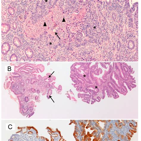 Histopathology Of The Endoscopic Colonic Biopsy Hematoxylin And Eosin