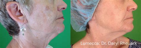 Before After Plastic Surgery In Knoxville Tn Premier Surgical