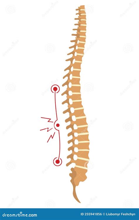 Spinal Deformity Symbol Of Spine Curvatures Or Unhealthy Backbones