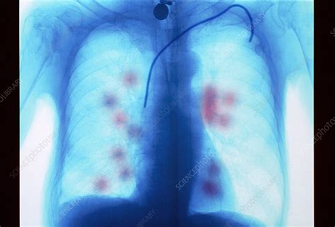 Secondary Lung Cancer X Ray Stock Image C0349471 Science Photo Library