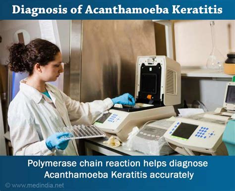 Acanthamoeba Keratitis Symptoms Signs Diagnosis And Treatment