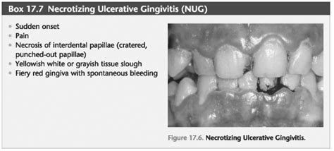 Necrotizing Periodontal Diseases - Foundations of Periodontics ...