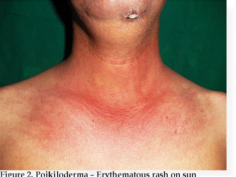 Figure 2 From CUTANEOUS MANIFESTATIONS OF DERMATOMYOSITIS IN MALE