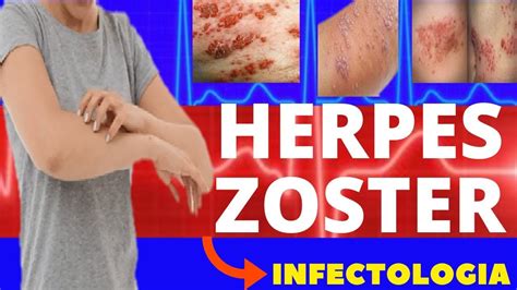 Herpes Zoster O Que Sintomas Diagn Stico E Tratamento Varicela