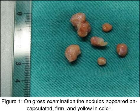 Figure 1 From Testicular Adrenal Rest Tumor Mimicking Leydig Cell Tumor