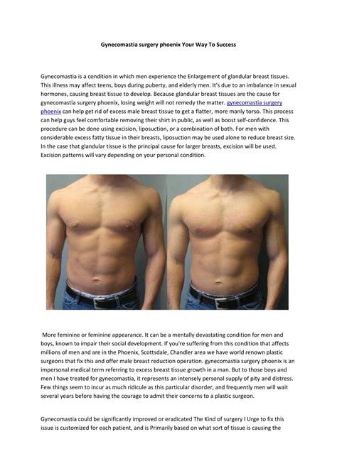 Ppt Gynecomastia Surgery Phoenix Powerpoint Presentation Free