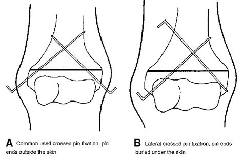 Supracondylar Humerus