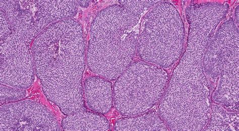 Solid Papillary Carcinoma Of The Breast Ottawa Atlas Of Pathology