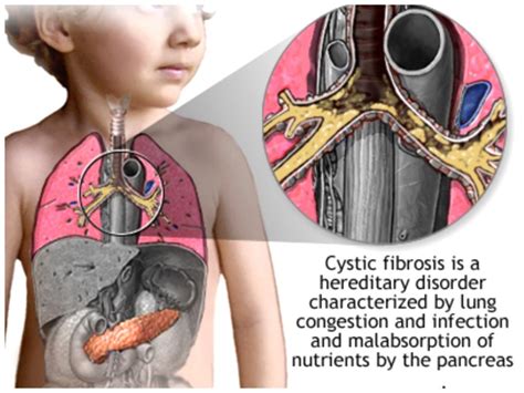 Early Detection Treatment Of Cystic Fibrosis May Stop Vital Organs