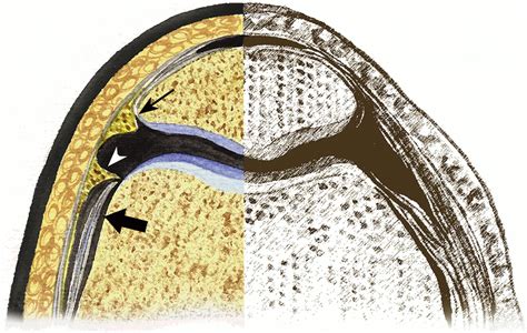 Anatomy And Mr Imaging Appearances Of Synovial Plicae Of The Knee