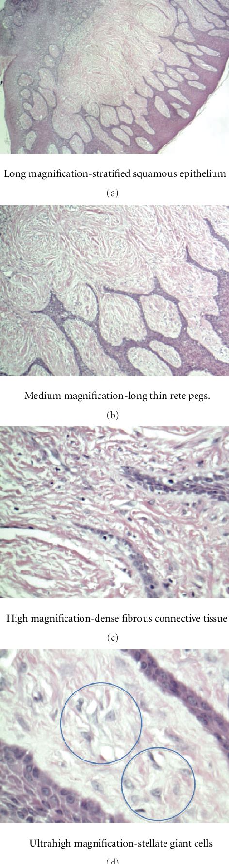 [PDF] A Giant Cell Fibroma and Focal Fibrous Hyperplasia in a Young Child: A Case Report ...