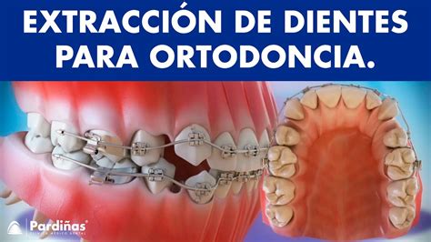 Extracción De Dientes En Ortodoncia © Youtube