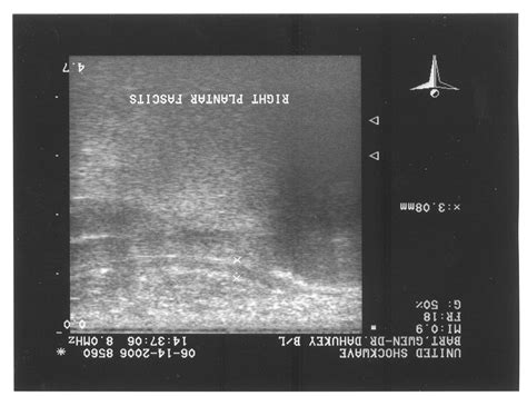 Plantar Fascia Ultrasound