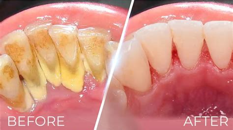 Dental Calculus Before And After