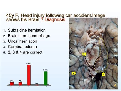 Pathology of Head Injury