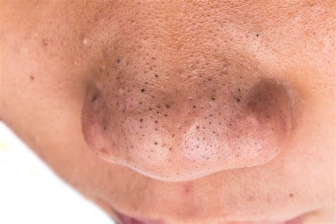 What Is A Blackheads At Mary Smyth Blog