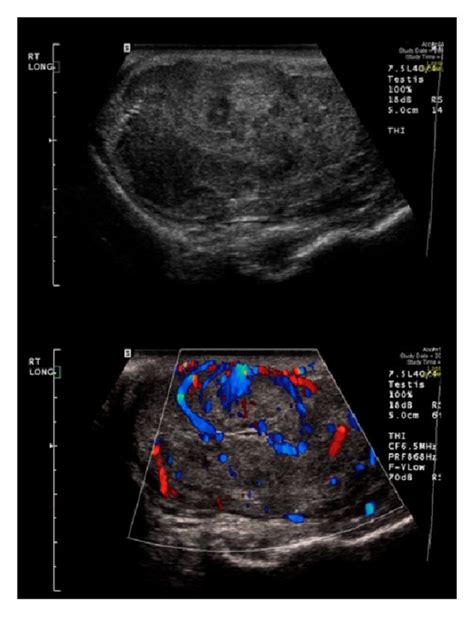 Right Testicular Ultrasound Showing A Testicular Mass With Flow On