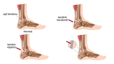 A Il Tendonu Nedir A Il Tendonu Kopmas Ve Tedavisi