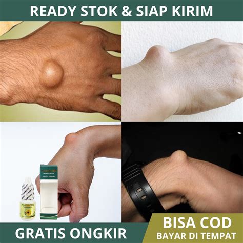 Jual Obat Kista Ganglion Penghancur Benjolan Ganglion Benjolan Lipoma