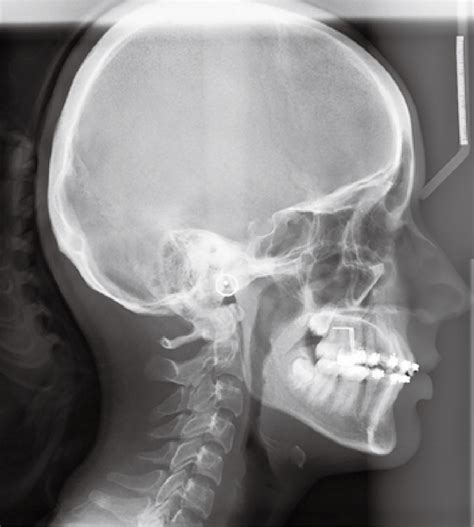 A Sample Of A Lateral Cephalometric Radiograph That Was Considered As