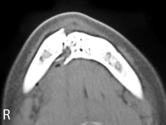 Preoperative Axial Computed Tomography Ct View Showing Horizontally