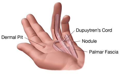 La Enfermedad De Dupuytren Todo Lo Que Necesitas Saber