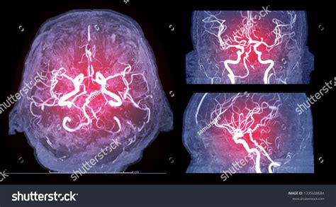 Mra Scan Images Stock Photos Vectors Shutterstock