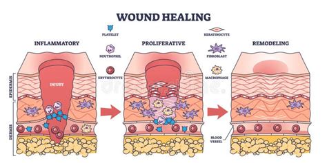 Process Of Wound Healing And Anatomical Body Injury Repair Outline