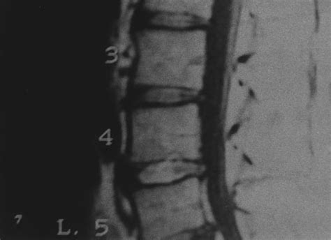 Magnetic Resonance Tomography Showing The Prolapsed Intervertebral Disc Download Scientific