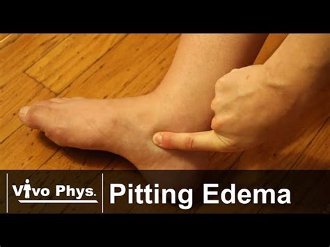 Pitting Edema Vs Non Pitting Edema What S The Difference Off