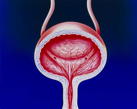 Illustration Of A Female Bladder With Cystitis Photograph By John